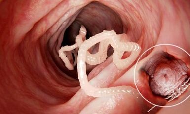 How to recognize the presence of parasites in the human gut