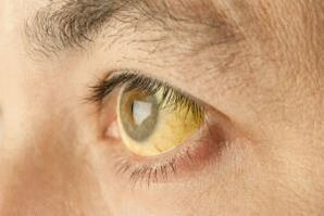 yellowing of the whites of the eye